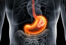 Helicobacter pylori, the bacteria that can cause stomach cancer