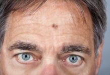 Which skin cancer is more aggressive?