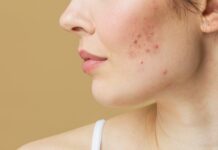 These viruses can help fight acne