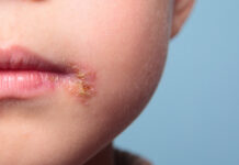 The cold sore possibly spread when we started kissing