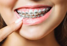 The dangerous fashion that has gone viral: fake braces