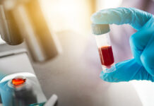 A blood test could detect Alzheimer's before it shows symptoms
