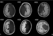 Can you live with only half a brain?