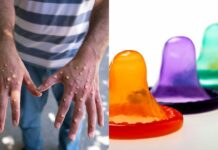 Is monkeypox transmitted even if you use a condom?