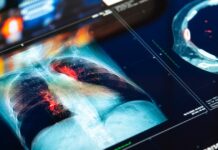 It's not COVID and it's not the flu: Third person dies from pneumonia of unknown origin in Argentina